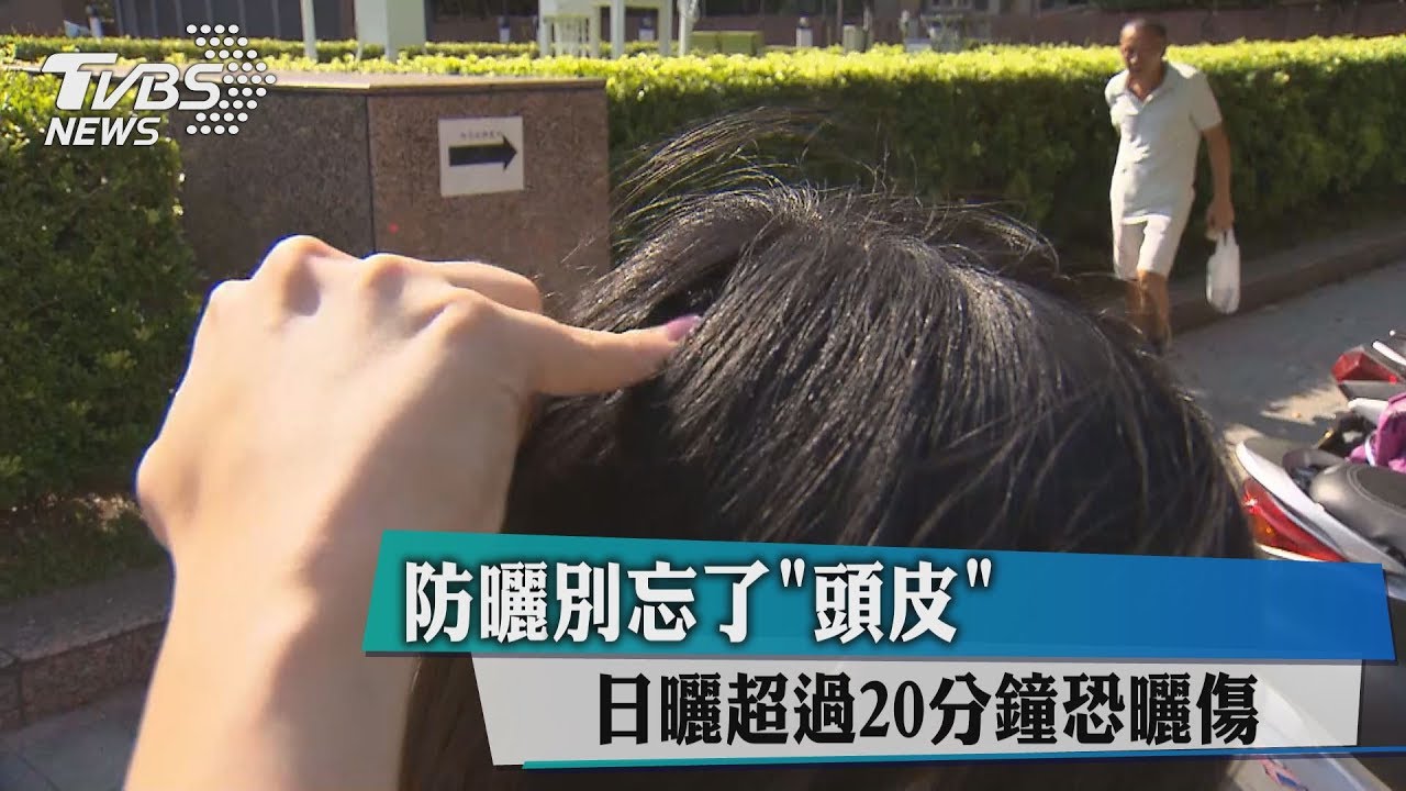 防曬別忘了頭皮！　日曬超過20分鐘恐曬傷