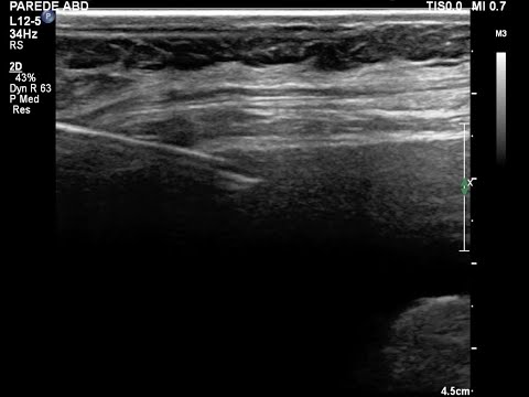 Paracentese guiada pela ultrassonografia. Recomendação da técnica.