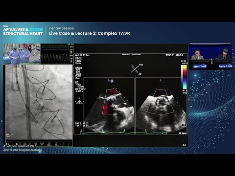 [AP VALVES & SH 2023] Live Case & Lecture 2: Complex TAVR