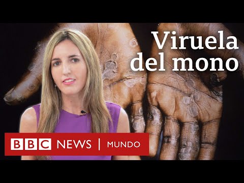 , title : 'Cuáles son los síntomas y cómo se transmite la viruela del mono | BBC Mundo'