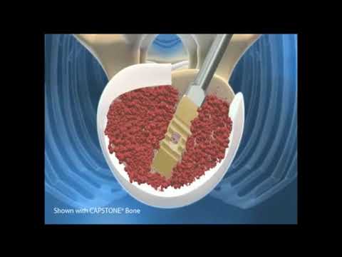 MIS TLIF (Minimally Invasive Lumbar Decompression and Instrumentation) Surgery