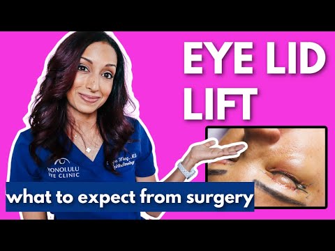 Understanding Eyelid Surgery (Blepharoplasty)