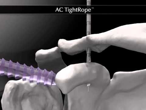 Arthrex   AC TightRope®