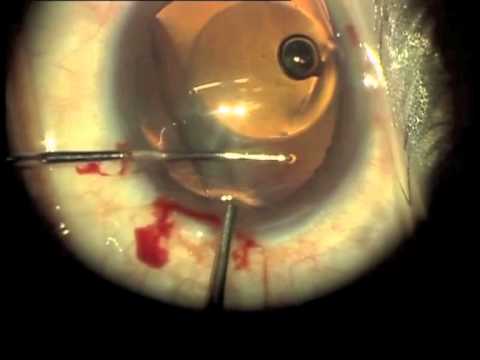 Removal of an ICL Intraocular corrective lens