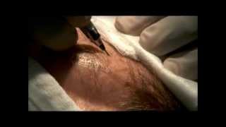 Hair Transplant Surgery Performed at Bosley Clinic: Before and After