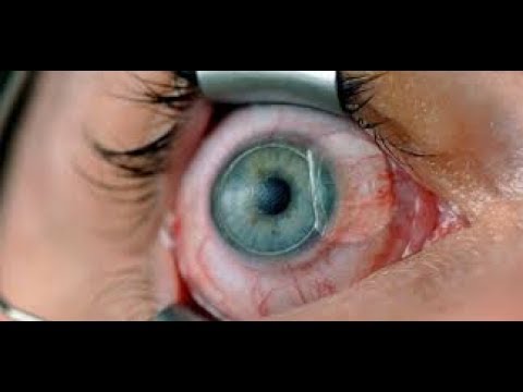 Demodex oftalmologie