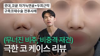 (무너진 비주, 비중격 재건) 극한코 케이스 리뷰 [늑떼선생김현주의 수술사례 및 케이스리뷰]