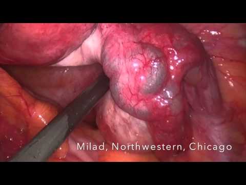 Surgical Treatment of Blocked Fallopian Tubes