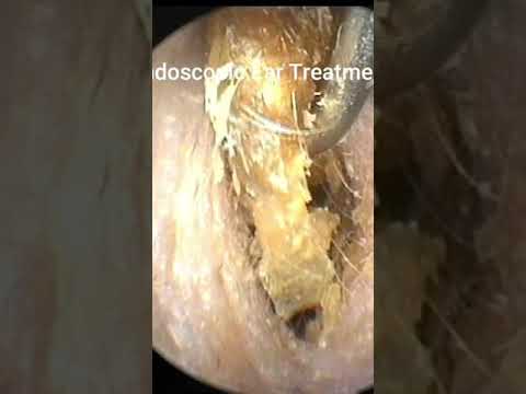 EAR WAX REMOVAL #shorts @Satisfying Cleaner