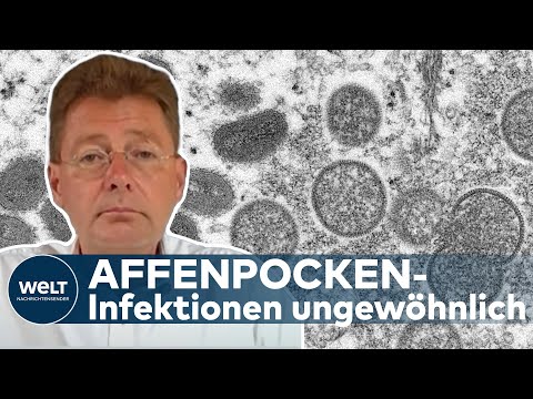 AFFENPOCKEN IN DEUTSCHLAND: Lauterbach-Ministerium erwartet Anstieg der Infektionen | WELT Thema