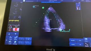 How to measure strain on the GE Vivid echo machines