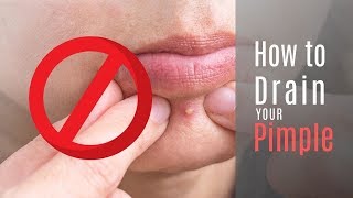 How to Drain Your Pimple to Get Rid of a Popped Pimple Scabs!