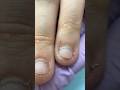 Extreme Bitten Nails Transformation
