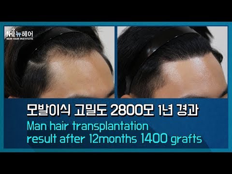 모발이식 2800모 1년 Man hair transplantation (FUSS) result after 12months 1400 grafts (뉴헤어)