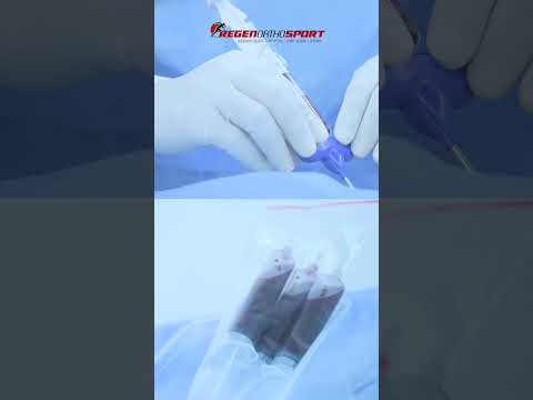 Advanced Minimally Invasive Treatment for Hip AVN | RegenOrthoSport