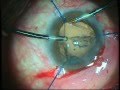 phacoemulsification of subluxated lens with iris ...