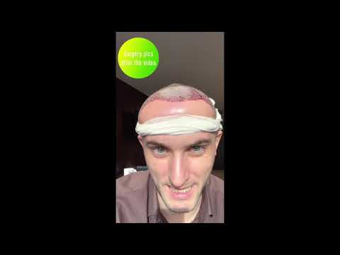 First Day after FUE Hair Transplant in Tijuana, Mexico