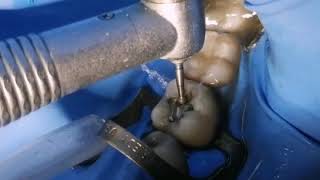 Retiro de amalgama y colocación de restauración estética Dr. Ricardo Garcia