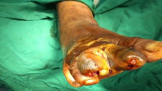 Wet gangrene| Diabetic foot| Osteomyelitis| Toe disarticulation| Amputation| Wound debridement