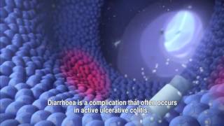 Treating Ulcerated Colitis with Pentasa