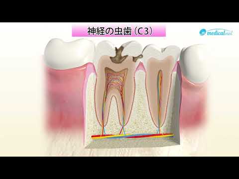 虫歯について詳しく解説