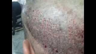 preview picture of video 'post surgery donor area after FUE.MP4'