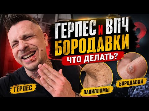 Бородавки, папилломы, герпес — откуда берутся и как убрать
