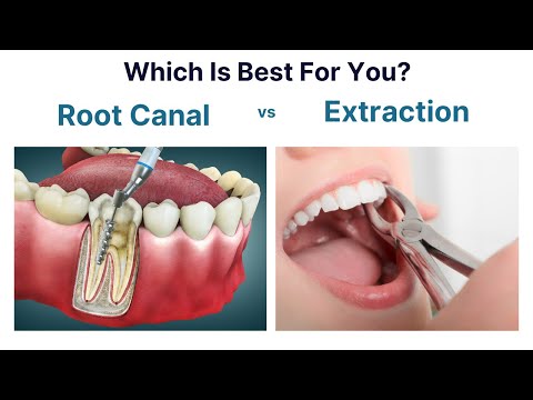 Root Canal Treatment or Tooth Extraction: A Guide To Deciding What's Best For You