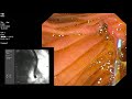 ERCP Long CBD Stricture From Extrahepatic Cholangiocarcinoma
