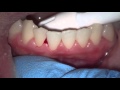 evaluating bleed gums