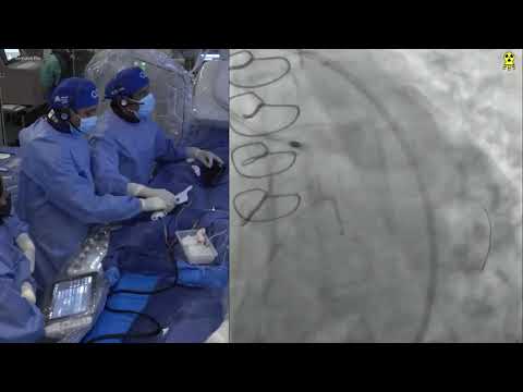 Live Case Presentations #4, #5 and #6 - Calcified Bifurcation Lesions