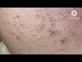 Super Blackheads HoangMySpa24