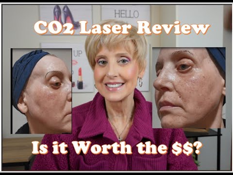 CO2 Laser Resurfacing Review! Is it Worth the $$$!