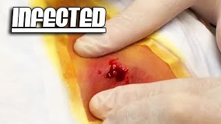 Abscess, Abscesses, Infected Abscess Revisited - Blackhead Facial Mask 2018