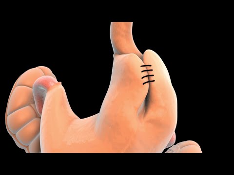 Heartburn and GERD Surgery