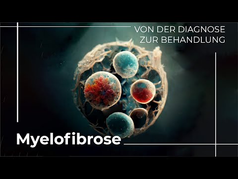 Ist Myelofibrose-Krebs heilbar?