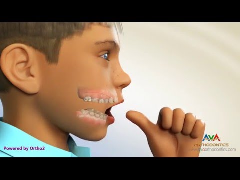 Orthodontic Treatment for Thumb Sucking - Habit Breaker Appliance