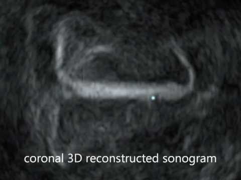 Intrauterine Device on Transvaginal Ultrasound