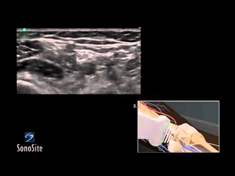 How To: Ultrasound Guided Popliteal Sciatic Nerve Block 3D Video