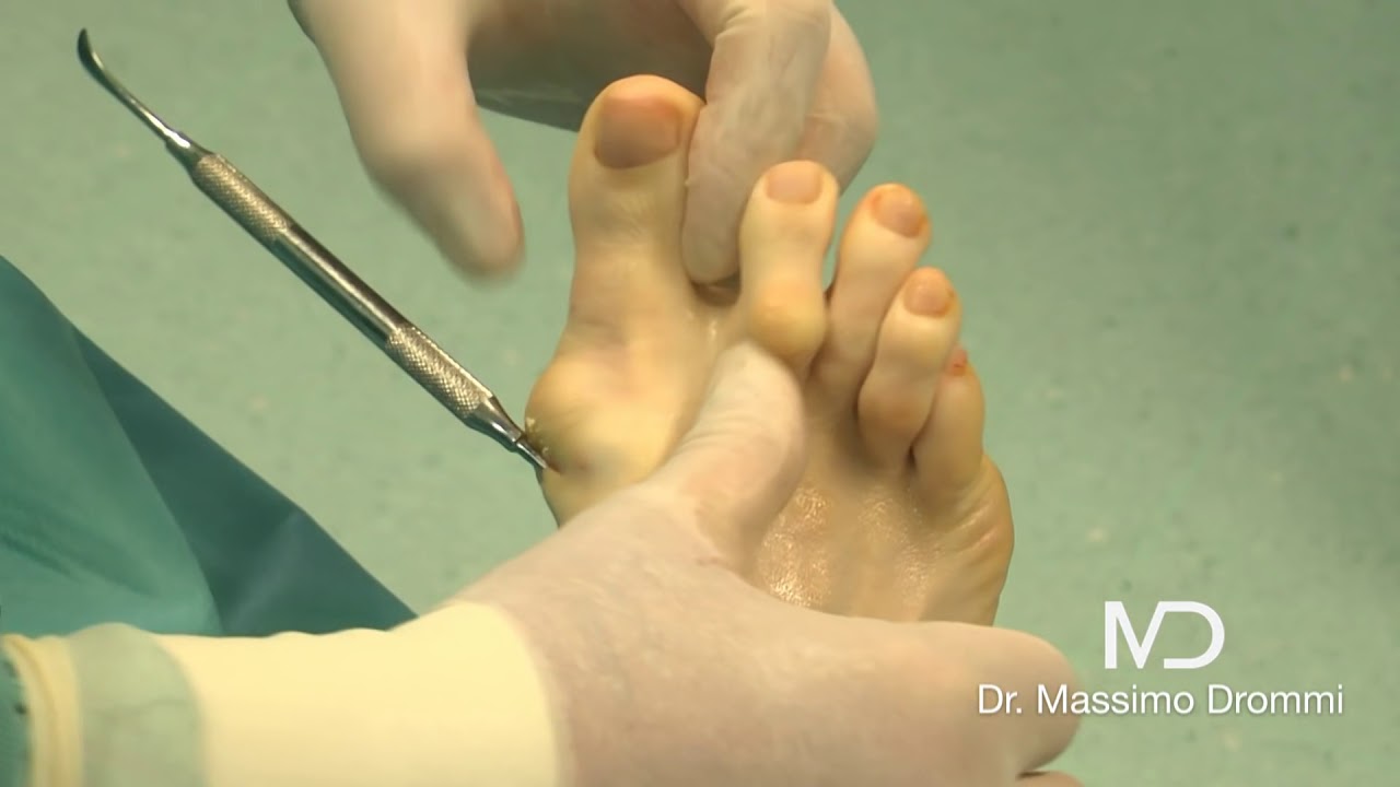 Correzione Percutanea dell'Alluce valgo severo e del dito a martello - Dott. Massimo Drommi