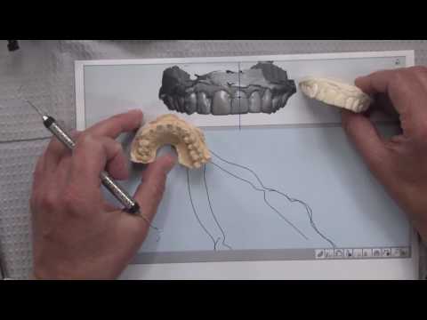 Case of the Week: Utilizing CAD/CAM Technology to Please Patient and Practitioner