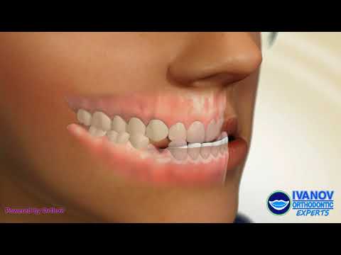 How to fix Underbite with Braces