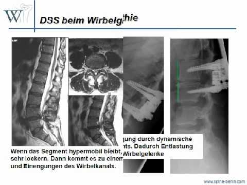 Dynamische - bewegliche Stabilisierung