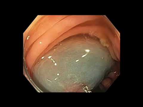 Colonoscopia - RME de lesión sutil de colon descendente - técnica de SNARE FLIP