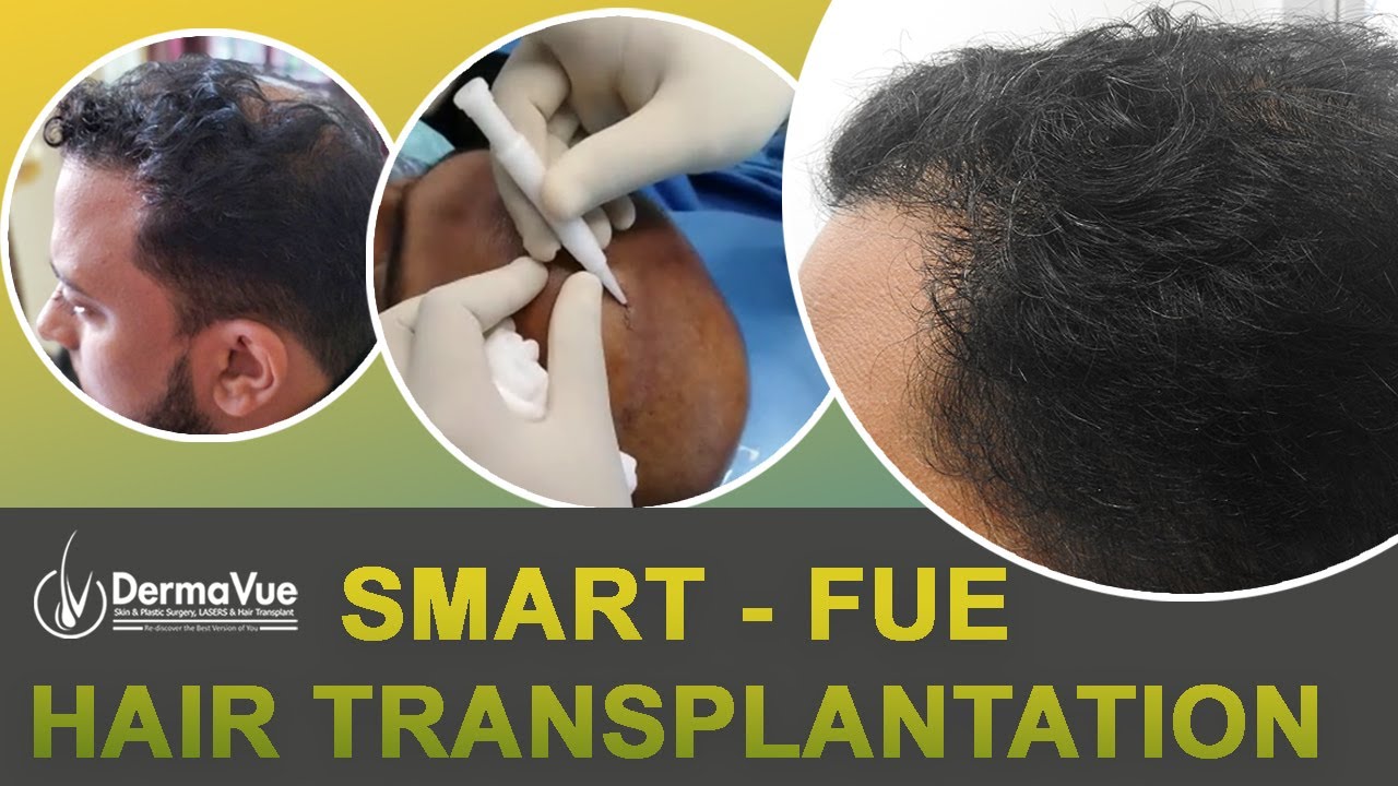 12-Month Follow-Up — Natural Hairline Results