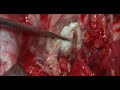 INTRA ORBITAL LARGE  MENINGIOMA -MICROSURGERY-dr suresh dugani/HUBBALLI/INDIA