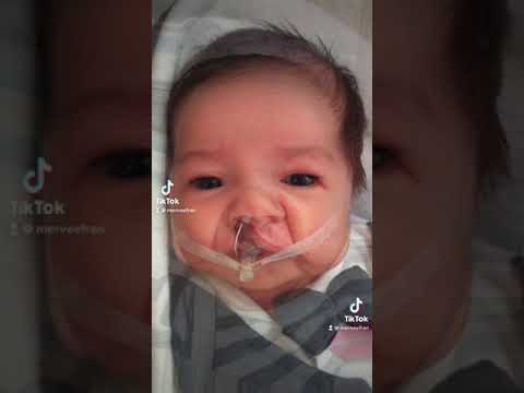 Yarık damak yarık dudak