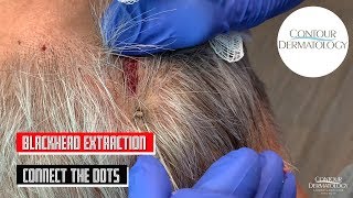 Blackheads Extraction From Behind the Head (Connect The Dots)