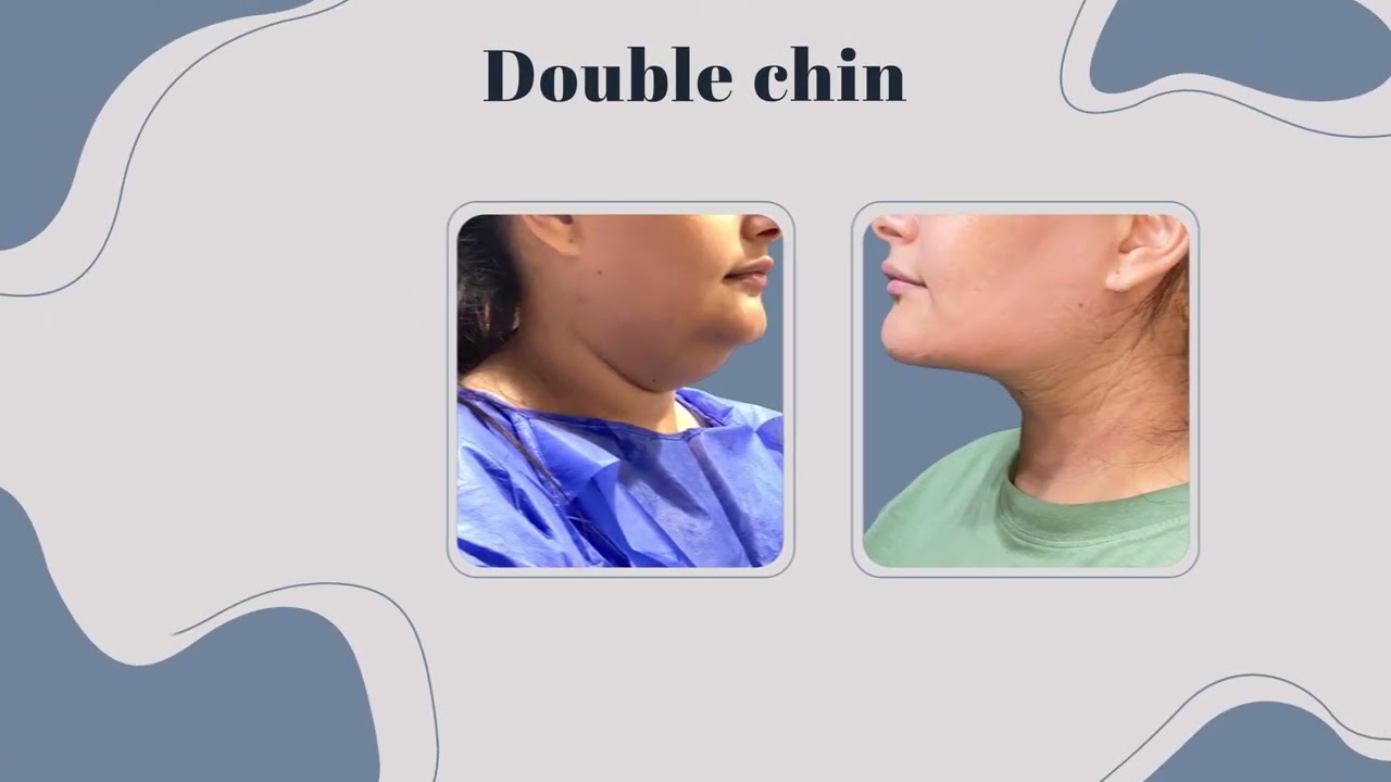 أفضل نتائج لشد الوجة مع الدكتور طارق بدر