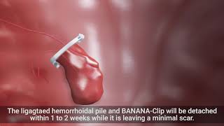 [ENDOVISION CONSUMABLE] Hemorrhoid Ligation Clip, BANANA CLIP